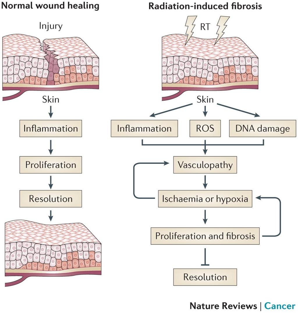 Normal wound healing vs radiation-induced fibrosis pathway