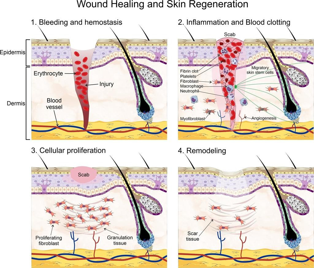 Wound healing and skin regeneration process — hemostasis, inflammation, proliferation, remodeling